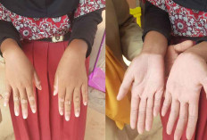 Bupati Beltim Perhatikan Kesehatan Siswa SD 10 Gantung, Turun Tangan Bantu Pengobatan Alergi Anak