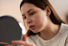 5 Bahan Alami Penghilang Bekas Jerawat, Aman dan Terbukti Efektif