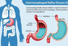 Makanan Sehari-hari yang Diam-diam Picu GERD: Bukan Cuma Pedas dan Asam