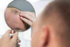 Dokter Spesialis Ungkap Cara Terbaik Mengatasi Kebotakan Rambut