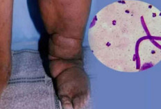 Filariasis atau Kaki Gajah: Gejala, Penyebab, dan Pencegahan