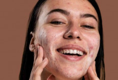 4 Tips Skincare untuk Rosacea: Rahasia Kulit Cantik Bebas Keluhan