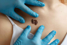 Waspadai! Ini Ciri Tahi Lalat Berbahaya yang Bisa Jadi Kanker Kulit