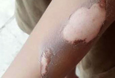 Bocah Piatu di Belitung Dianiaya Sepupu, Luka Bakar di Tubuhnya Bikin Pilu