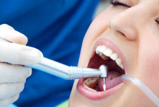 Cara Scaling Gigi Gratis Pakai BPJS Kesehatan, Ini Syarat dan Prosedurnya